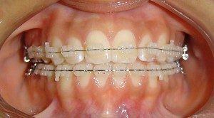 Ortodoncia fija con brackets estéticos